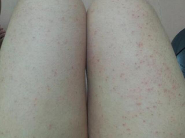 螨虫叮咬图片-皮肤过敏螨虫照片-螨虫症状脸部图片